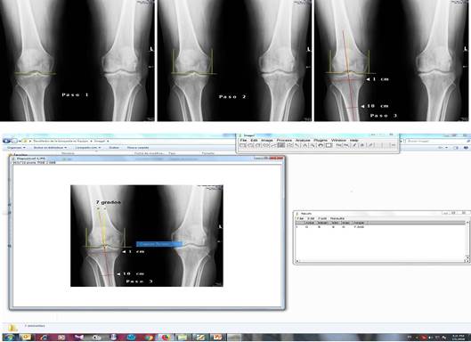 Arriba, pasos del uno al tres para la medici&oacute;n de la desviaci&oacute;n angular de la rodilla en esta ocasi&oacute;n el varo Abajo, medici&oacute;n realizada mediante el software libre ImageJ, paso 4.