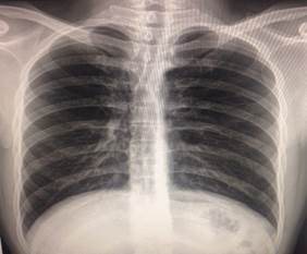 Rx de t&oacute;rax PA. No aparece silueta card&iacute;aca ni grandes vasos.