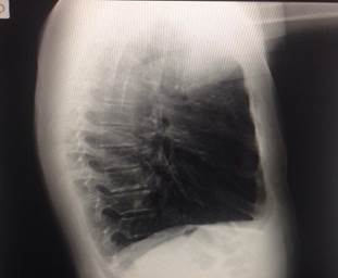 Vista L no se observa imagen del coraz&oacute;n ni grandes vasos.