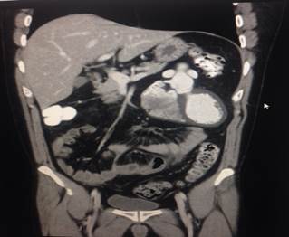 TAC contrastado de abdomen Coraz&oacute;n y vasos en abdomen superior.