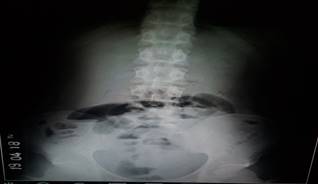 Radiografía de abdomen de pie.