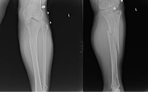 Obsérvese fracturas del platillo tibial externo, oblicua de la tibia y distal del peroné.