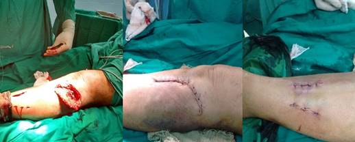 Abordajes quirúrgicos empleados, para la colocación de la lámina y tornillos de 4,5 milímetros.