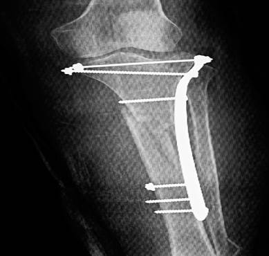 Paciente a los tres meses de operada, obsérvese extensión completa de la rodilla afectada y flexión de 80 grados.
