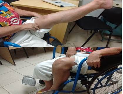 Paciente a los nueve meses incorporada a su vida normal, rango de movimiento normal y consolidación de las fracturas a los seis meses de operada.