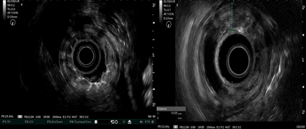 Im&aacute;genes ecogr&aacute;ficas mediante ultrasonido endosc&oacute;pico donde se observa engrosamiento difuso de todas la capas de la pared gastrica.