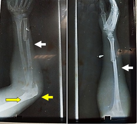 Izquierda: obsérvese fractura del cúbito a nivel del olecranon y unión del tercio medio y distal (flechas amarillas) además de luxación de la cabeza radial en dirección anterior (flecha color blanco). Derecha: proyección lateral del antebrazo donde se observa fractura del cúbito en sus tercios medio y distal (flecha blanca).