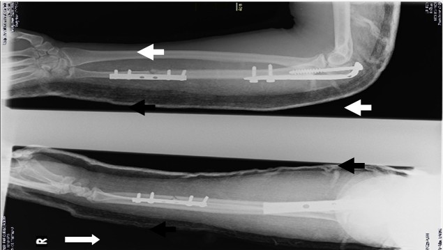 Obsérvese osteosíntesis del olecranon con placa semitubular moldeada de 4,5 milímetros y fijación de la fractura distal del cúbito con placa AO semitubular de 3,5 milímetros.