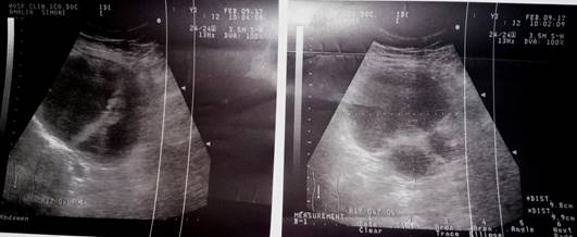 Imagen qu&iacute;stica de 12 cm, pared gruesa y celularidad aumentada.