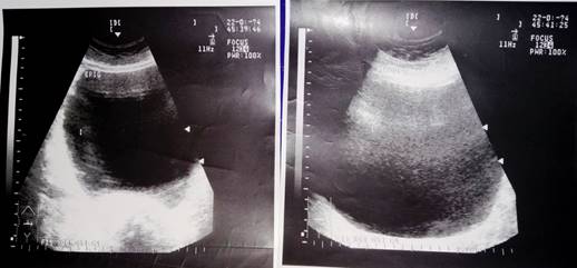 TQO de grandes dimensiones y di&aacute;metro entre 17 a 23 cm con celularidad aumentada.