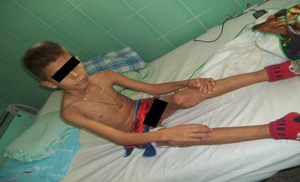 Escolar desnutrido, por debajo del tercer percentil en todos los par&aacute;metros, en l&iacute;nea de marasmo, durante el ingreso.