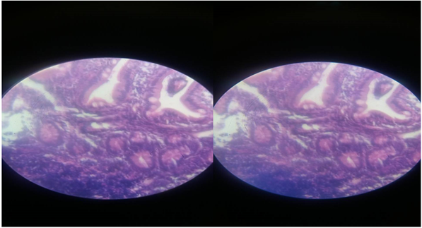 Estudio histol&oacute;gico de muestra de biopsia de duodeno: hiperplasia linfoide reactiva severa, atrofia parcial de vellosidades intestinales, con escasos eosin&oacute;filos en la l&aacute;mina propia.
