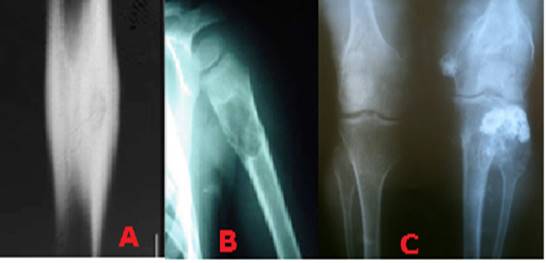A) Osteoma osteoide B) Quiste &oacute;seo esencial C) Exostosis m&uacute;ltiple hereditaria.