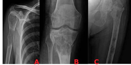 Lesi&oacute;n geogr&aacute;fica o tipo 1: A) Lesi&oacute;n l&iacute;tica de bordes n&iacute;tidos con anillo escler&oacute;tico B) Lesiones m&uacute;ltiples l&iacute;ticas de bordes n&iacute;tidos donde no se observa anillo escler&oacute;tico C) Lesi&oacute;n l&iacute;ticade bordes mal definidos.