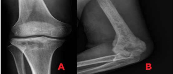 Lesi&oacute;n no geogr&aacute;fica: A) Lesi&oacute;n apolillada de la tibia tipo II.B) Lesi&oacute;n l&iacute;tica del h&uacute;mero mal definida de aspecto permeativo tipo III.