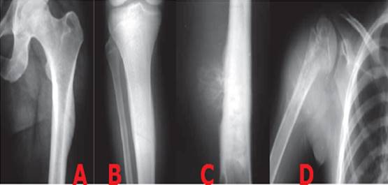 A) Reacci&oacute;n s&oacute;lida o unilaminada B) en capas de cebolla C) en rayos de sol D) tri&aacute;ngulo de Codman.