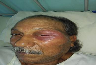 Se observa aumento de volumen en región orbito-cigomática izquierda y eritema palpebral.