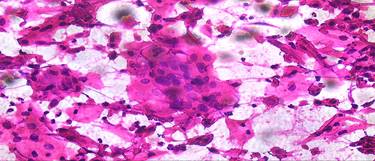 Análisis histopatológico del tumor.