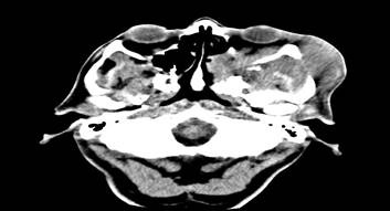 TAC de senos paranasales (Corte axial).