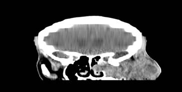 TAC de senos paranasales (Corte coronal).