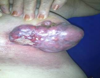 Sarcoma de mama que infiltra piel del tórax.