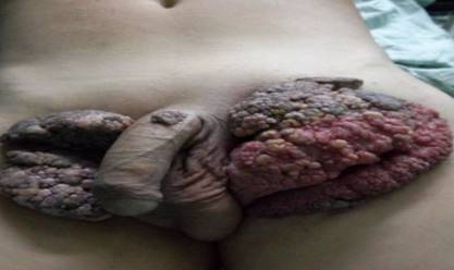 Vista anterior del tumor de Buschke-Lowenstein.