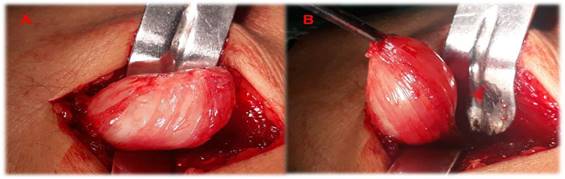Cirug&iacute;a. A: exposici&oacute;n del tumor bien encapsulado mediante disecci&oacute;n roma. B: tumor disecado casi en su totalidad. N&oacute;tese fibras musculares adheridas al tumor.