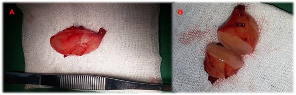 Pieza anat&oacute;mica. A: forma ovoide del tumor de 45 X 30 mil&iacute;metros. B: n&oacute;tese contenido gelatinoso del tumor.