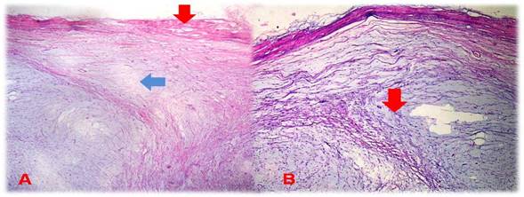 Histolog&iacute;a. A: se visualizan los haces musculares en la periferia (flecha roja) zona hipovascular e hipocelular (flecha azul). B: abundante matriz mixoide extracelular (flecha roja).
