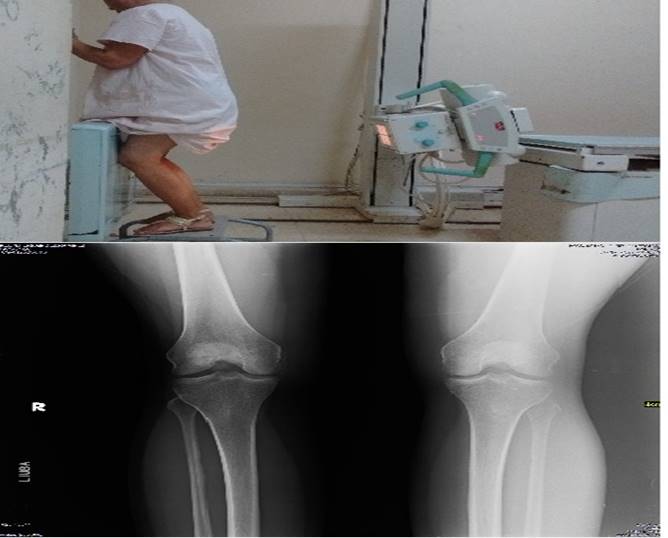 Radiograf&iacute;a postero-anterior en proyecci&oacute;n de Rosenberg TD et al. 22