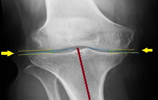 M&eacute;todo del punto medio, l&iacute;nea roja vertical se lleva a cabo por los puntos medios de la tibia proximal y distal, l&iacute;neas azules oblicuas se trazan desde el bode m&aacute;s exterior de la mesetas a las espinas tibiales correspondientes. L&iacute;neas verdes son paralelas a la l&iacute;nea central de la tibial en el punto medio de las l&iacute;neas azules oblicuas. L&iacute;neas amarillas paralelas miden el verdadero espacio articular.