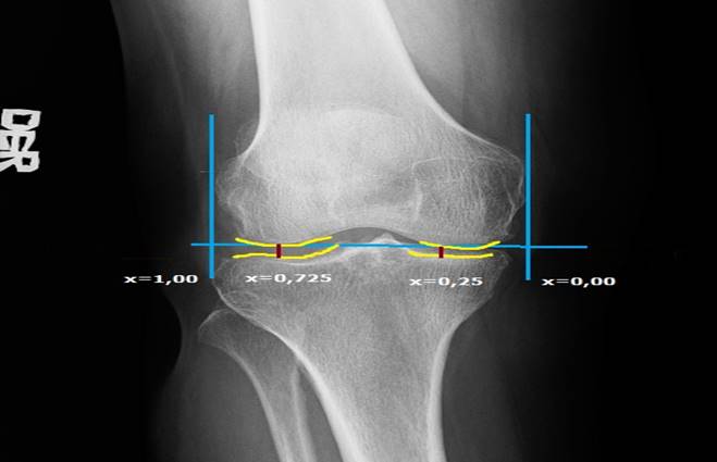 M&eacute;todo de la superficie. Se dibujan los contornos de los c&oacute;ndilos femorales y los de la tibia proximal (amarillo), se traza una l&iacute;nea que une los dos c&oacute;ndilos femorales y dos l&iacute;neas que interceptan esta &uacute;ltima en 90 grados que se tienen como referencia los puntos m&aacute;s externos de los c&oacute;ndilos medial y lateral (azul). Luego, se identifican de esta l&iacute;nea el punto 0,25 y 0,725 donde se trazan dos l&iacute;neas rojas verticales paralelas a las azules de los c&oacute;ndilos y se realiza la medici&oacute;n del espacio tibiofemoral. 