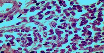 Microfotografías de corte histológico de melanoma maligno de piel.