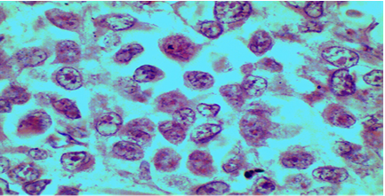 Microfotografías de corte histológico de melanoma maligno. Coloración hematoxilina y eosina. Se aprecian los núcleos de las células tumorales.