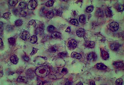 Microfotografías de corte histológico de melanoma maligno. Coloración hematoxilina y eosina. Se aprecian los núcleos de las células tumorales.