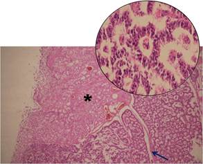 Lesión tumoral a nivel de la submucosa con superficie mucosa intacta (*), formada por islotes separados por tabiques fibrovascular (fecha) (10X). Círculo superior vista 40X.