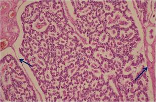 Disposición de las células en forma de en rosetas y de tabiques fibrovascular (fecha) (20X).