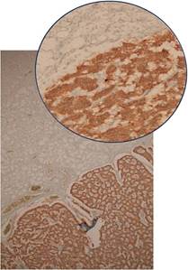 Tinción de inmunohistoquímica con cromogranina (10x y 40x).