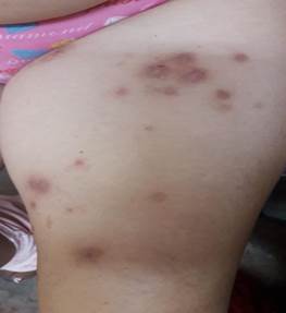 Lesiones autoinflingidas.