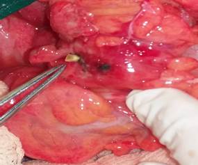 Colon descendente: observe fragmento &oacute;seo perforante in situ que proviene de la luz intestinal.