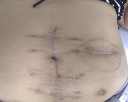 Estado actual de la pared abdominal.