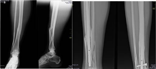 Fractura cerrada de la tibia derecha a nivel del tercio distal fijada mediante clavo intramedular fresado autocerrojado.