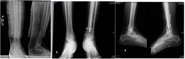 Fractura abierta tipo II seg&uacute;n la clasificaci&oacute;n de Gustilo RB y Anderson JT, 25 estabilizada con fijaci&oacute;n intramedular autocerrojada anterograda.