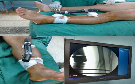 Fractura abierta grado I seg&uacute;n la clasificaci&oacute;n de Gustilo RB y Anderson JT, 25 del tercio distal de la tibia izquierda tratada mediante fijaci&oacute;n externa tipo Orthofix&reg;.