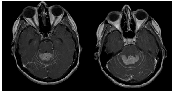 Resonancia nuclear
magn&eacute;tica de cerebro simple corte axial donde se evidencia la lesi&oacute;n
metast&aacute;sica en el aspecto superior del vermis cerebeloso, con diseminaci&oacute;n leptomen&iacute;ngea
alrededor de la lesi&oacute;n