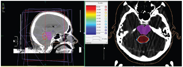 Planeaci&oacute;n de
radiocirug&iacute;a de lesi&oacute;n metast&aacute;sica en la fosa posterior. T&eacute;cnica: Step and
Shoot, dosis prescrita: 15 Gy, dosis m&iacute;nima: 9,752 Gy, dosis media: 15,548 Gy,
dosis m&aacute;xima: 16,962 Gy, &iacute;ndice de conformalidad: 0,8504, volumen total: 7,792
cm3, dosis al 98 % del volumen: 13,416 Gy, volumen que recibi&oacute; 15 Gy: 5,776
cm3, &iacute;ndice de heterogeneidad: 1,16