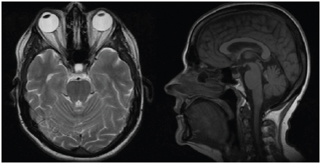 Resonancia nuclear
magn&eacute;tica cerebral de control con alteraci&oacute;n incipiente en el par&eacute;nquima
cerebral por encima del cuarto ventr&iacute;culo adyacente y por debajo del vermis