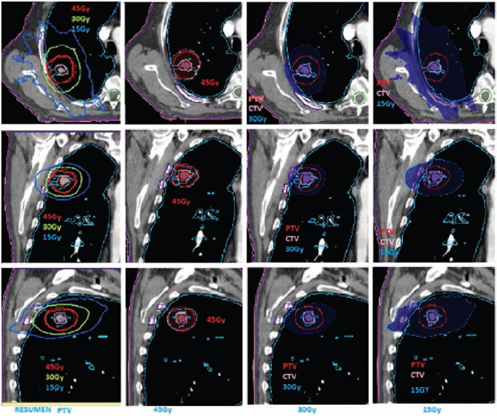 Hallazgos
dosim&eacute;tricos PTV: volumen blanco de planeaci&oacute;n