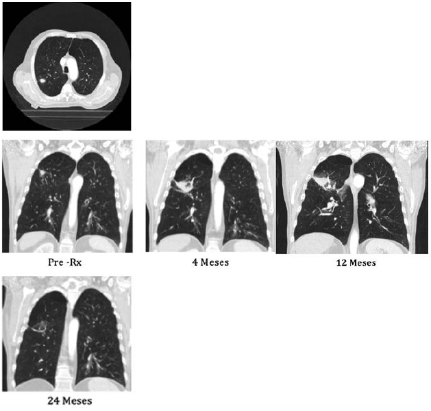 TAC
de pretratamiento y posterior a radioterapia corporal
estereot&aacute;ctica en el paciente.