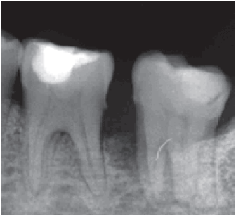 Radiograf&iacute;a
periapical previa